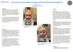 Early onset accommodative esotropia: treatment and management