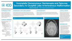 Incomplete Homonymous Hemianopia and Seizures Secondary to an Occipital Lobe Arteriovenous Malformation