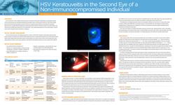 HSV Keratouveitis in the Second Eye of a Non-Immunocompromised Individual