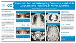 Supraclavicular lymphadenopathy secondary to metastatic lung carcinoma presenting as Horner Syndrome