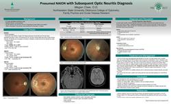 Presumed NAION with Subsequent Optic Neuritis Diagnosis