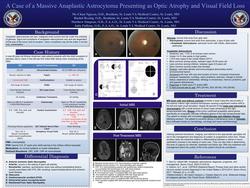 A Case of a Massive Anaplastic Astrocystoma Presenting as Optic Atrophy and Visual Field Loss