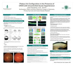 Plateau Iris Configuration in the Presence of CRVO with Uncontrolled Ocular Hypertension