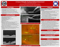 Diabetic peripapillary tractional retinal detachment