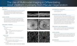 The Use of Multimodal Imaging in Differentiating Adult Vitelliform Dystrophy from Age-Related Macular Degeneration