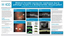 Bilateral choroidal neovascular membranes due to pathologic myopia in a developmentally delayed patient