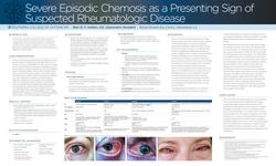 Severe Recurrent Chemosis as a Presenting Sign of Suspected Rheumatologic Disease