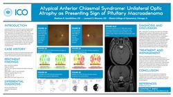 Atypical Anterior Chiasmal Syndrome: Unilateral Optic Nerve Atrophy as Presenting Sign of Pituitary Macroadenoma