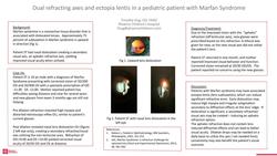 Dual refracting axes in ectopia lentis in a pediatric patient with Marfan's Syndrome