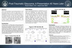 Post-Traumatic Glaucoma: A Presentation 45 Years Later