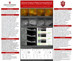 Multimodal Imaging of Multiple Evanescent White Dot Syndrome and Impact on Diagnosis and Management