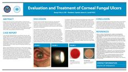 The Evaluation and Treatment of Corneal Fungal Ulcers