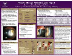 Presumed Fungal Keratitis: A Case Report