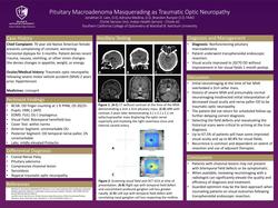 Pituitary Macroadenoma Masquerading as Traumatic Optic Neuropathy