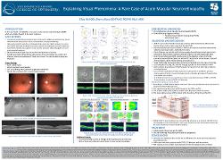 Explaining Visual Phenomena: A Rare Case of Acute Macular Neuroretinopathy