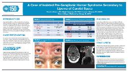 A Case of Isolated Pre-Ganglionic Horner’s Syndrome Secondary to Lipoma of the Carotid Space