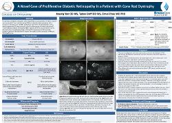 A Novel Case of Proliferative Diabetic Retinopathy in a patient with Cone Rod Dystrophy