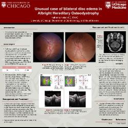 Unusual case of bilateral disc edema in setting of Albright Hereditary Osteodystrophy